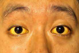 يرقان أو صفار العين والجلد (Jaundice): دليلك الطبي لفهم أسبابه الحقيقية